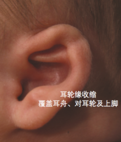2,耳轮脚横凸:耳甲腔中耳轮脚异常突起1,垂耳:耳轮自身折叠二:常见