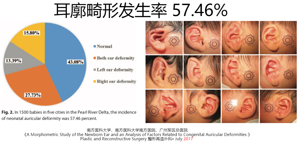 新生儿外耳畸形可以矫正了