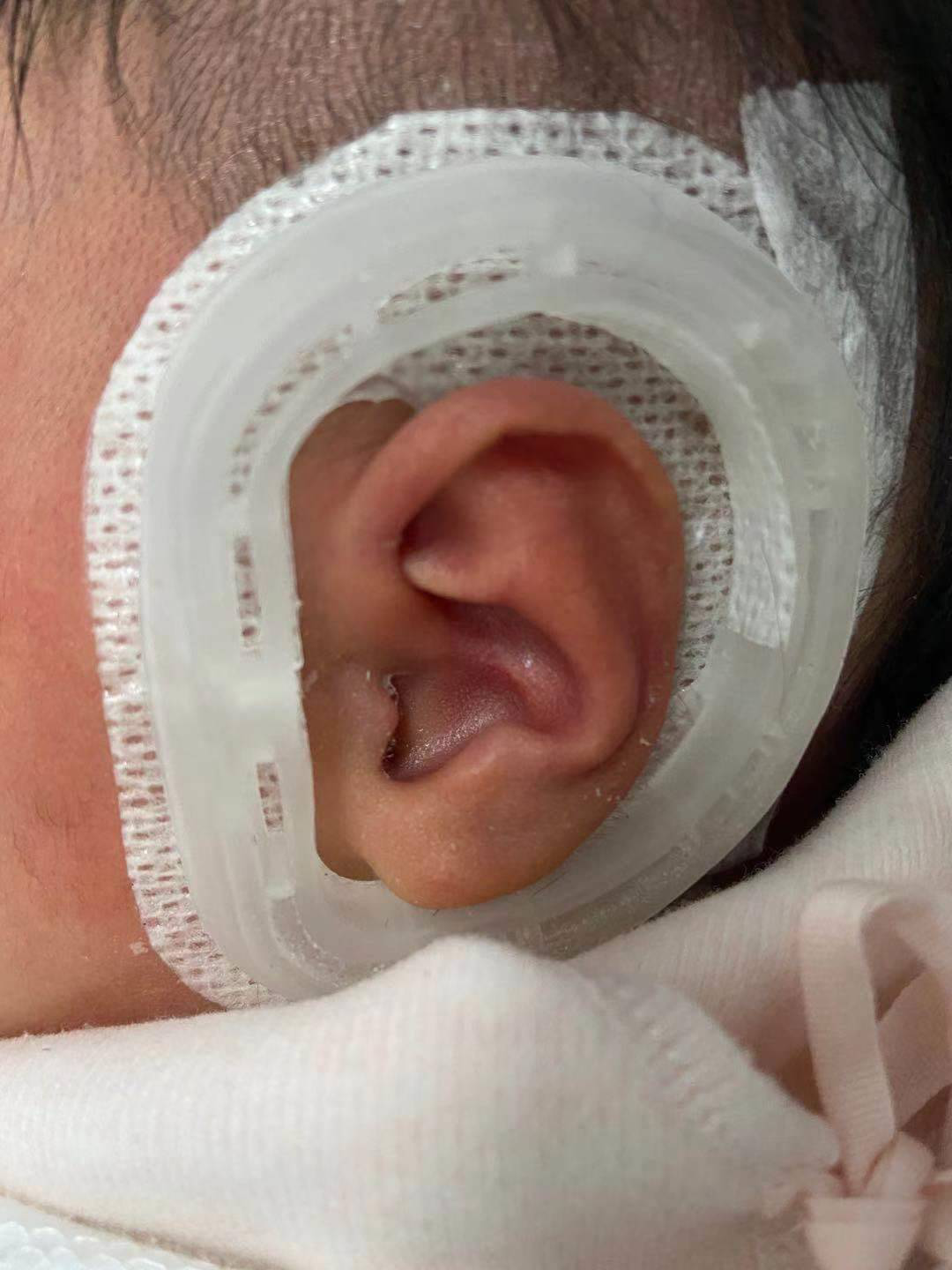 新生儿外耳畸形可以矫正了